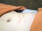 acupuncture, physiotherapy, wellness-4175624.jpg