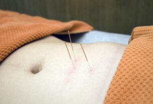 acupuncture, physiotherapy, wellness-4175624.jpg